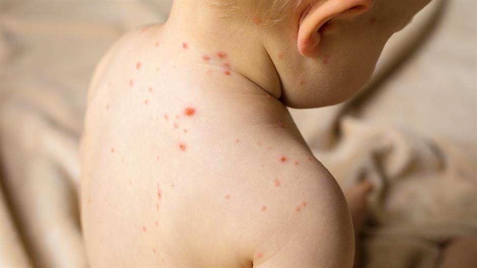 Majčin imunitet štiti bebe od malih boginja samo prva tri meseca